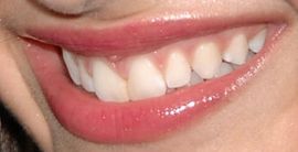 Picture of Demi Lovato's teeth while smiling