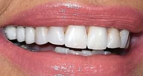 Picture of Denise Richards teeth and smile