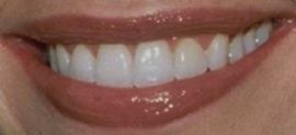 Picture of Denise Richards teeth and smile