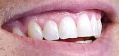 Denny Hamlin's teeth and smile