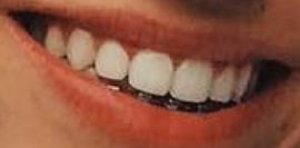 Picture of Dixie D'Amelio teeth and smile