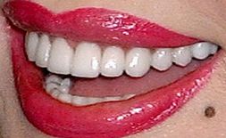 Picture of Dolly Parton teeth and smile