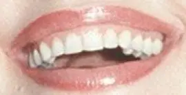 Picture of Dolly Parton teeth and smile