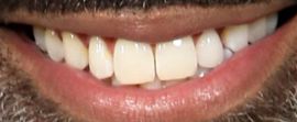 Picture of Donnell Turner teeth and smile