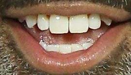 Picture of Donnell Turner teeth and smile