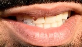 Picture of Drake teeth and smile