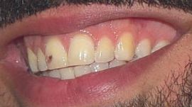 Picture of Drake teeth and smile