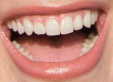Dua Lipa teeth