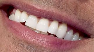 Picture of Dwayne Johnson The Rock's teeth while smiling