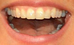 Picture of Ellen DeGeneres teeth and smile