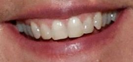 Picture of Ellen DeGeneres teeth and smile