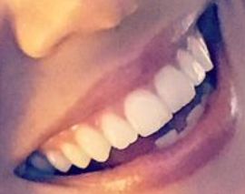 Picture of Emilie Ullerup teeth and smile