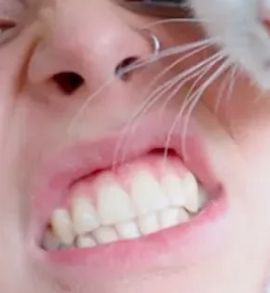 Emma Chamberlain's teeth