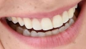 Picture of Emma Watson teeth and smile