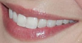 Picture of Emme Rylan teeth and smile