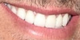 Picture of Eric Martsolf teeth and smile
