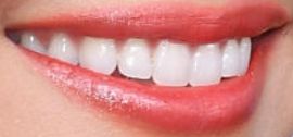 Picture of Erin Lim teeth and smile