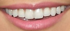 Picture of Erin Lim teeth and smile
