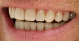 Picture of Ewan McGregor teeth and smile