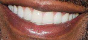 Floyd Mayweather Jr's teeth and smile