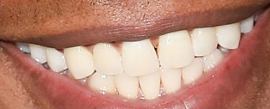 Picture of Gaius Charles teeth and smile