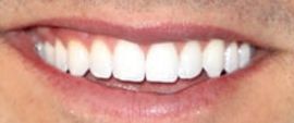 Picture of Garrett Yrigoyen teeth and smile