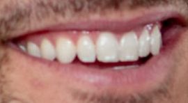 Picture of Garrett Yrigoyen teeth and smile