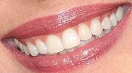 Picture of Genie Francis teeth and smile