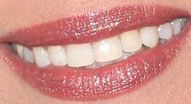 Picture of Genie Francis teeth and smile
