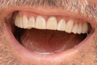 George Clooney's teeth