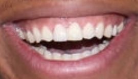 Picture of Giannis Antetokounmpo teeth and smile