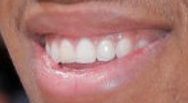 Picture of Giannis Antetokounmpo teeth and smile