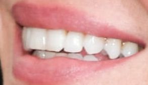Picture of Gisele Bundchen teeth and smile