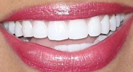 Picture of Gizelle Bryant teeth and smile