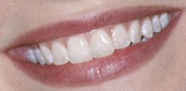 Picture of Gwyneth Paltrow's teeth and smile while smiling