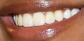 Picture of Halima Aden teeth and smile