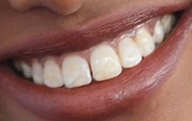 Picture of Halima Aden teeth and smile