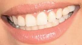 Picture of Halsey teeth and smile