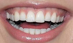 Picture of Hannah Brown teeth and smile