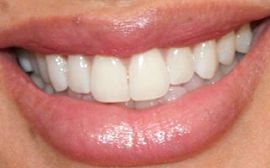 Picture of Heather Rae Young teeth and smile