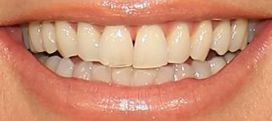 Picture of Heidi Klum's teeth and smile while smiling