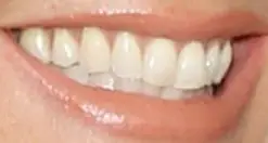 Picture of Heidi Klum's teeth and smile while smiling