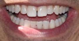 Picture of Helio Castroneves teeth and smile