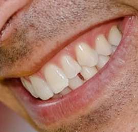Picture of Helio Castroneves teeth and smile