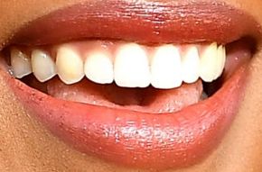 Picture of H.E.R. teeth and smile