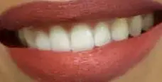 Picture of H.E.R. teeth and smile