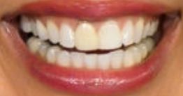 Hoda Kotb's teeth and smile