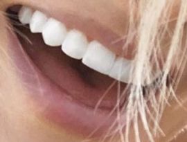 Picture of Holly Madison teeth and smile