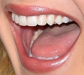 Picture of Hunter King teeth and smile