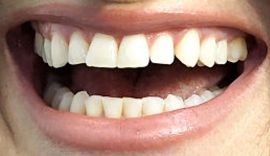 Picture of Idina Menzel teeth and smile